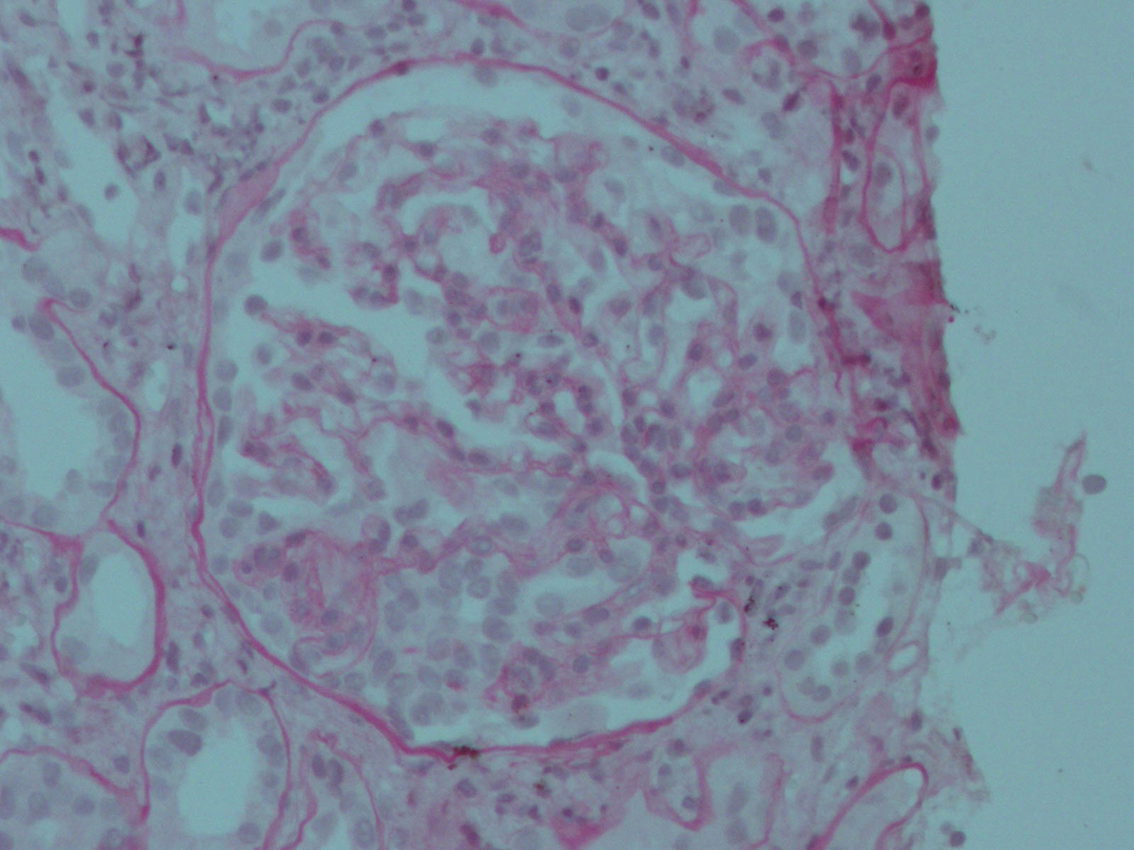 Tincin H/E 400X. Glomrulo aumentado de tamao, con rea de expansin e hipercelularidad mesangial leve, rigidez segmentaria y colapso capilar, hipertrofia e hiperplasia de podocitos