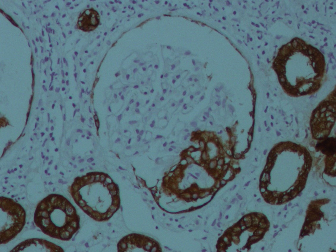 Inmunohistoqumica 400X: Panqueratina (+) en zona de colapso capilar y en tbulos renales, que presentan degeneracin turbia