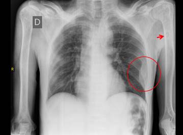 Radiografía de tórax. Muestra lesión expansiva en 6° y 7° arco costal izquierdo