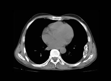 Tomografía de tórax. Se observa lesión lítica en 6° y 7° arco costal izquierdo