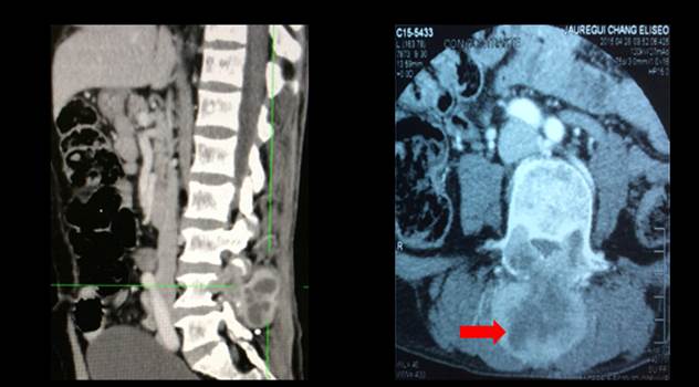 Tomografía de columna lumbosacra, muestra lesión neoformativa a nivel L4 patrón de camiseta de jugador de rugby