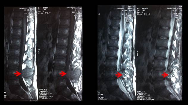 Resonancia magnética de columna lumbosacra, muestra lesión estenosante a nivel L4-L5