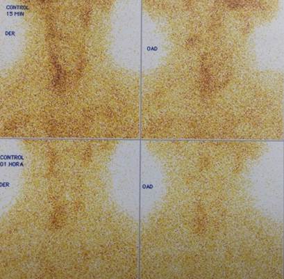 Gammagrafía de paratiroides: imagen inicial de glándula tiroidea con ligera mayor captación a nivel de lóbulo derecho. Las imágenes tardías muestran persistencia leve de área captante mencionada de bordes mal definidos a nivel del polo inferior del lóbulo derecho de la tiroides con borramiento de la imagen tiroidea.