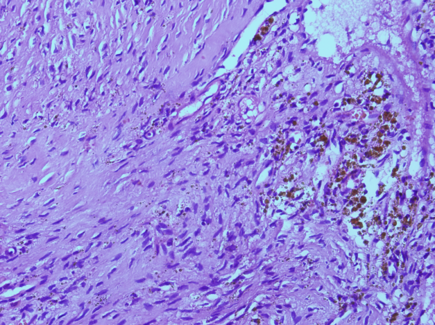 Biopsia de lesión vertebral. El estudio anatomo-patológico mostró reacción fibrohistiocítica con formación de hueso reactivo y cambios de quiste óseo aneurismático en relación con tumor pardo debido a hiperparatiroidismo