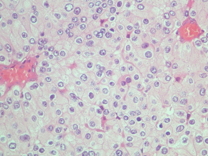 Estudio anatomo-patológico de paratiroides: adenoma oxifilico de paratiroides
