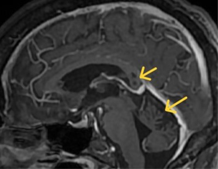 Brain magnetic resonance imaging sagittal T1 sequence, post-contrast, showing hypointensity of the splenium lesion and cerebellar vermis atrophy, no enhancement by the contrast.