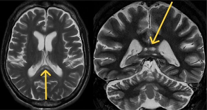 Brain magnetic resonance imaging axial and coronal T2 sequences showing hyperintense lesions, without mass effect, involving the splenium of the corpus callosum.