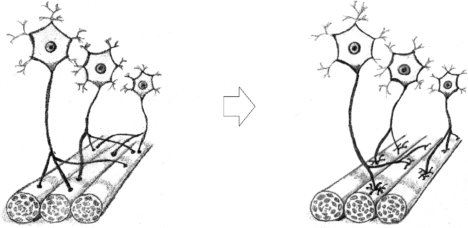 Poda sináptica por
retracción de ramales axónicos en una unión neuromuscular. Durante el proceso:
a) disminuye el número de axones que van a parar a un mismo miocito y
también el número de miocitos a los que va a parar un mismo axón, b) se
refuerzan los vínculos neurona-miocito supervivientes mediante la formación de
sinapsis adicionales. Aunque, en aras de una mayor simplicidad, se muestra
el resultado final en forma de «un axón, un miocito», esto no constituye
una norma  
(ilustraciones: Daniela Guevara)
