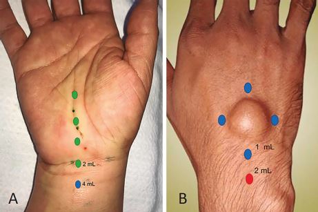 (A) En cirugía de túnel del carpo, se inicia el primer punto a 2 cm proximal al pliegue de la muñeca, colocando 4 ml de la solución, luego sucesivamente en los puntos marcados. (B) Puntos para la aplicación de la solución anestésica en cirugía de ganglión dorsal.