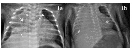 a. Ensanchamiento del cardiomediastino (flecha doble) con leve desviaci&oacute;n del mismo a la izquierda, asociado a opacidad parenquimatosa compleja del hemitorax derecho (flecha larga) sin mayor broncograma a&eacute;reo, con velamiento de &aacute;ngulos costo y cardiofr&eacute;nicos e im&aacute;genes de niveles hidroa&eacute;reos y/o cavidades a&eacute;reas (pseudoqu&iacute;sticas) de esta base pulmonar y al parecer extendida o comunicada al cardiomediastino (flecha corta); tambi&eacute;n hay desviaci&oacute;n de columna a&eacute;rea a la izquierda (*) y probable derrame subpulmonar derecho asociado. b. Opacidad hemit&oacute;rax derecho por derrame pleural masivo (flecha corta), y atelectasia adyacente, desplazamiento del cardiomediastino a la izquierda (lecha larga).