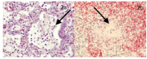 a. Pulm&oacute;n en fase alveolar con severo infiltrado inflamatorio PMN neutr&oacute;filo con formaci&oacute;n de abscesos; se reconocen algunos linfocitos maduros reactivos y macr&oacute;fagos. b. Par&eacute;nquima pulmonar con p&eacute;rdida de la arquitectura dado por &aacute;reas de hemorragia reciente y necrosis de licuefacci&oacute;n.