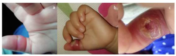 a. D&iacute;a 2, compromiso del tercio medio del pulgar, mano izquierda. Edema, eritema y punto central indurado (Inicio de Cefalexina). b. D&iacute;a 4, con persistencia de gran edema, mayor eritema, dolor a la palpaci&oacute;n y centro verdoso. Limitaci&oacute;n a la movilizaci&oacute;n y rubor (suspensi&oacute;n de Cefalexina e inicio de Clindamicina). c. D&iacute;a 7, postdrenaje espont&aacute;neo de colecci&oacute;n, aparici&oacute;n de costras y descamaci&oacute;n peri-lesional.