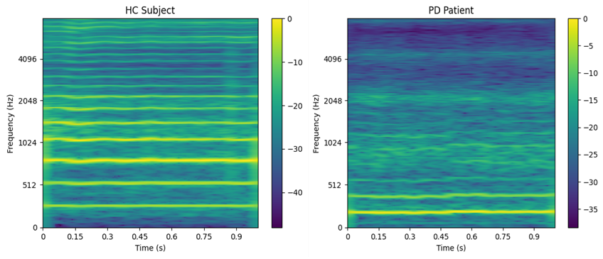Spectrogram representation example. HC (69 years) vs PD (65 years). PD: Patient suffering from Parkinson&rsquo;s disease. HC: Healthy control