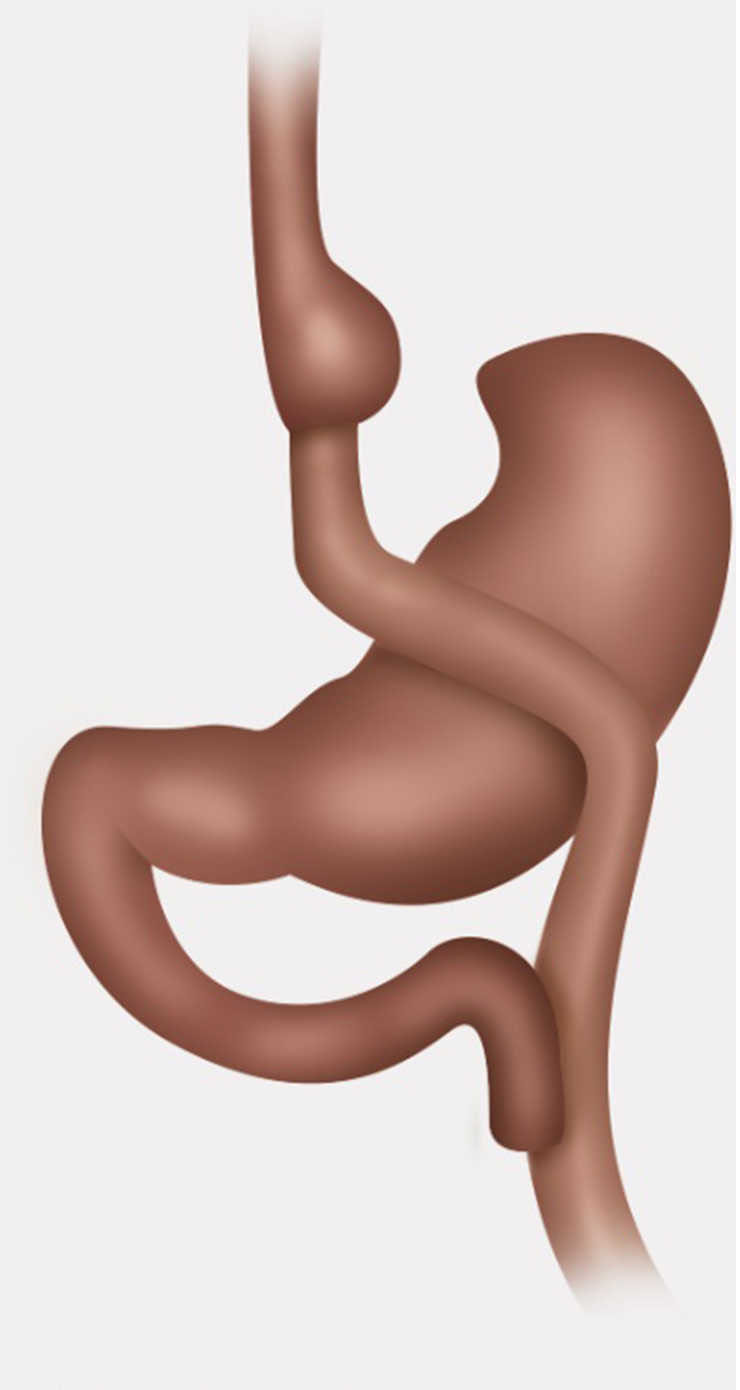 Bypass gástrico con Y de Roux.