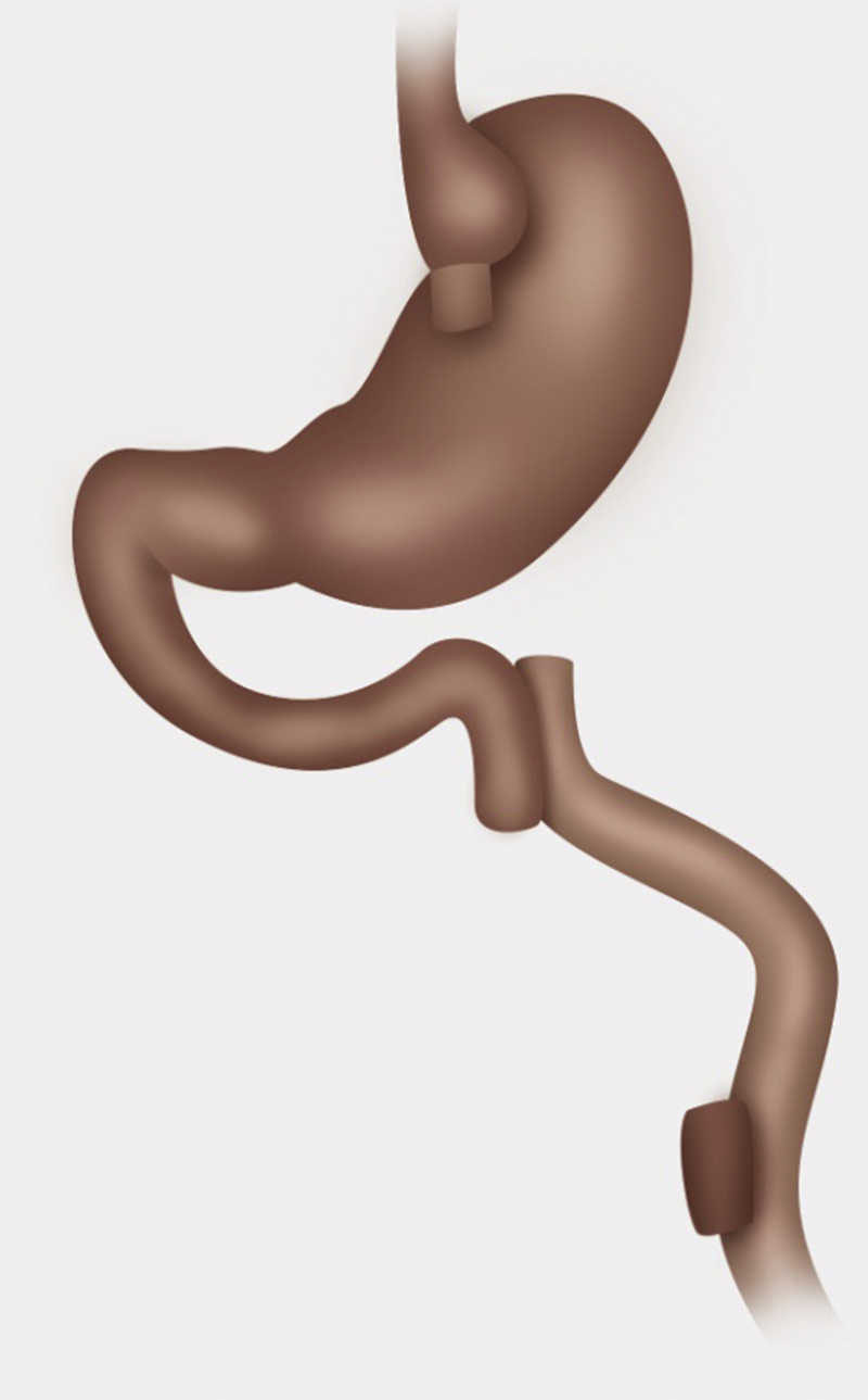 Bypass gástrico revertido a anatomía normal.