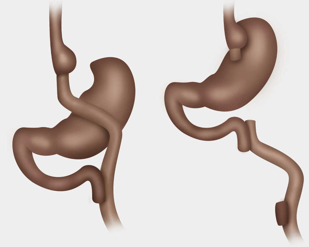 Comparación de Bypass gástrico con Y de Roux y anatomía normal restituida.