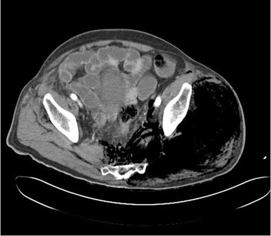 TC pélvico. Enfisema subcutáneo.