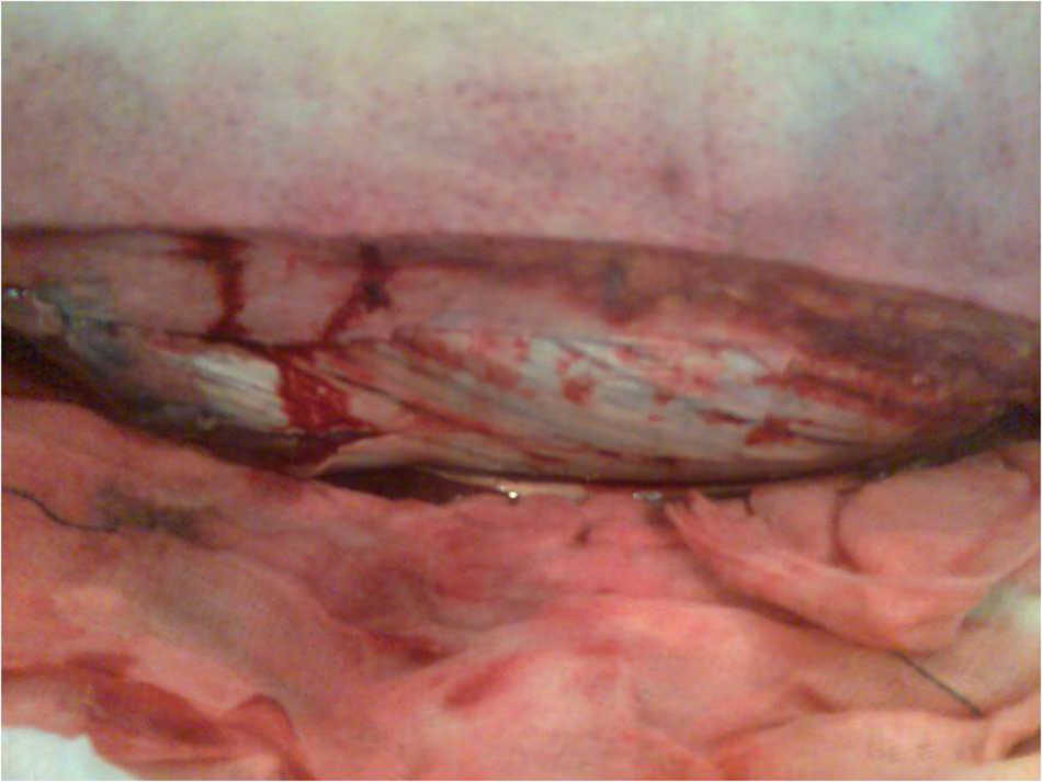 Desbridamiento en extremidad inferior.