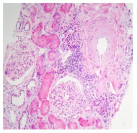Causa de p&eacute;rdida del injerto del caso 15. Ri&ntilde;&oacute;n trasplantado 
  con aterosclerosis grave. Se demostr&oacute; en los glom&eacute;rulos aumento 
  de la celularidad mesangial y dep&oacute;sitos de complejos inmunitarios 
  subepiteliales, subendoteliales, mesangiales e intramembranosos, 
  tanto en la inmunofluorescencia como en la microscop&iacute;a electr&oacute;nica. 
  En el momento de la biopsia, la paciente ten&iacute;a una recurrencia del 
  compromiso renal por lupus eritematoso sist&eacute;mico. Hematoxilina 
  y eosina, 100X.