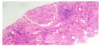 Causa de p&eacute;rdida del injerto del caso 4. Ri&ntilde;&oacute;n con aumento  de la matriz mesangial glomerular, esclerosis glomerular difusa, 
  atrofia tubular, fibrosis intersticial e hialinosis arterial, asociados 
  a diabetes mellitus. Hematoxilina y eosina, 100X.