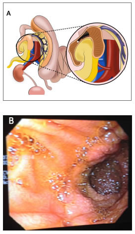 Trasplante simult&aacute;neo de ri&ntilde;&oacute;n y p&aacute;ncreas con derivaci&oacute;n 
  exocrina hacia el duodeno. A. La derivaci&oacute;n exocrina mediante 
  una duodeno-duodenostom&iacute;a permite el acceso endosc&oacute;pico al  injerto pancreato-duodenal. B. Visi&oacute;n endosc&oacute;pica del injerto 
  pancreato-duodenal en un paciente con trasplante simult&aacute;neo de 
  ri&ntilde;&oacute;n y p&aacute;ncreas.
