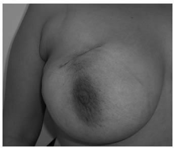 C&aacute;ncer de mama derecha con una previa biopsia por 
incisi&oacute;n en localizaci&oacute;n inadecuada.