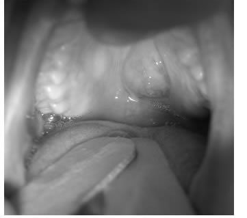 Tumor de paladar duro accesible a biopsia por incisi&oacute;n
  bajo anestesia local.