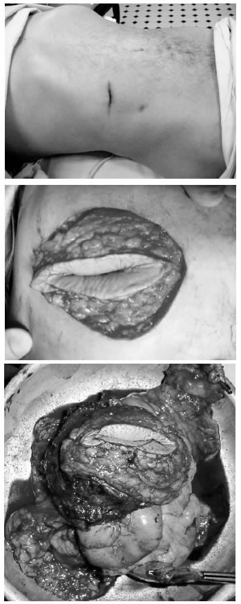 Recurrencia de tumor de colon sobre cicatriz de colostom&iacute;a y resecci&oacute;n tridimensional que incluye la pared abdominal.