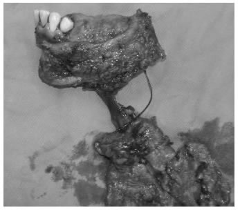 Producto de glosomandibulectom&iacute;a con vaciamiento 
  radical modificado izquierdo en bloque.