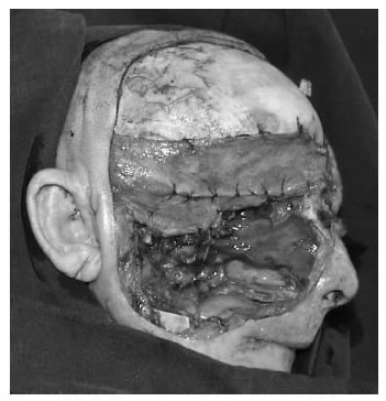 Lecho de reconstrucci&oacute;n de una resecci&oacute;n de suprameso-infraestructura ampliada a la mand&iacute;bula, que en ausencia de
  reconstrucci&oacute;n microquir&uacute;rgica inmediata, desmejoran en grado
  sumo la calidad de vida del paciente.