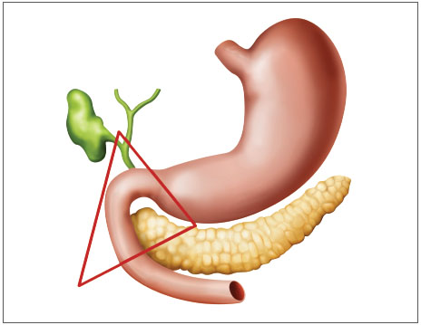 Triángulo del gastrinoma: área anatómica comprendida
    entre un ángulo superior que corresponde a la unión del conducto
    cístico con el conducto hepático común, un ángulo inferior formado
    por la unión de la segunda y la tercera porciones del duodeno, y un
    ángulo medial que corresponde a la unión del cuello y el cuerpo
    del páncreas.