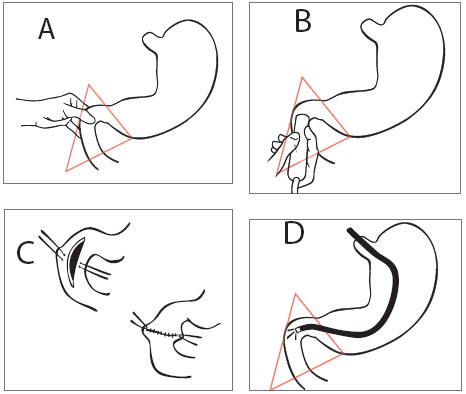 Métodos para la exploración quirúrgica del duodeno en 
la cirugía por síndrome de Zollinger-Ellison.