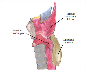 Ilustraci&oacute;n anat&oacute;mica del divert&iacute;culo de Zenker.
