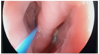 A la izquierda, se observa la luz esof&aacute;gica con la gu&iacute;a

hidrof&iacute;lica y, a la derecha, la luz del divert&iacute;culo.