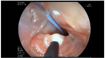 Secci&oacute;n del tabique del divert&iacute;culo con electrocauterio.