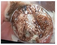 Secci&oacute;n del tabique del 
divert&iacute;culo 
con electrocauterio.