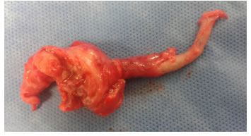 Apéndice cecal con apendicitis aguda y absceso.
Nótese
la fibrosis circundante