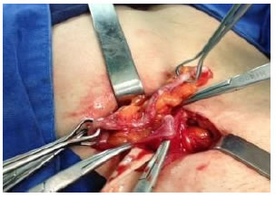 Apertura del saco herniario, extracci&oacute;n del 
ap&eacute;ndice cecal
y apendicectom&iacute;a a trav&eacute;s de este.
