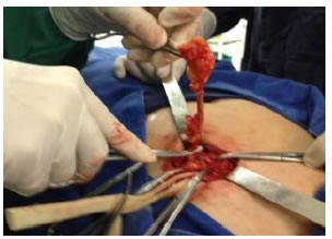 Disecci&oacute;n, ligadura y corte del meso ap&eacute;ndice, 
  con
  pinzamiento de la base apendicular y ligadura 
  a trav&eacute;s del saco
  herniario.
