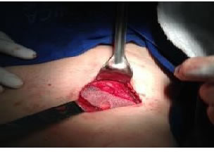 Colocaci&oacute;n de la malla y fijaci&oacute;n al ligamento de Cooper
con creaci&oacute;n de un neo anillo inguinal profundo, completando as&iacute;
la correcci&oacute;n completa de la hernia de Amyand.
