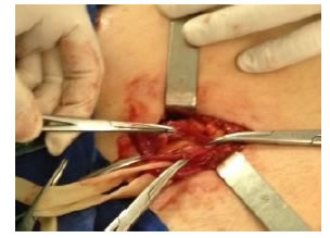 Disecci&oacute;n completa del saco herniario, identificaci&oacute;n
de los elementos del cord&oacute;n esperm&aacute;tico y ligadura alta del saco.