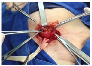 Hernia de Amyand: apendicitis aguda en 
fase edematosa
dentro de la hernia inguinal.