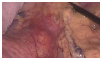 Identificaci&oacute;n de la lesi&oacute;n en la cola del p&aacute;ncreas.