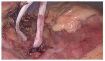 Identificaci&oacute;n y reparo de la arteria espl&eacute;nica.