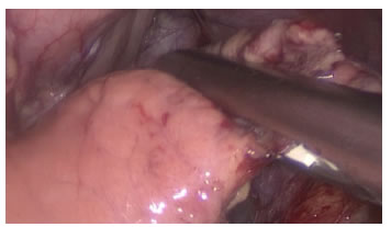 Pancreatectom&iacute;a distal con grapadora lineal.
