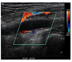 Ecografía Doppler de la extremidad inferior: se observa una lesión quística fusiforme localizada en el aspecto posterior de
la pared de la arteria poplítea, de 2,5 cm en su eje mayor. No se
demuestra flujo al estudio con Doppler a color.