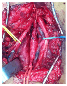 Imagen operatoria del abordaje posterior de la fosa poplítea: se observan la arteria poplítea rodeada por una cinta roja, la vena poplítea halada con una cinta azul y el nervio peroneo
señalado con la cinta amarilla. Nótese la masa del gran quiste de la adventicia arterial.