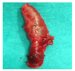 Pieza macroscópica de la arteria poplítea resecada con
su quiste en la adventicia.