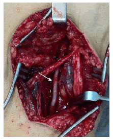 Imagen operatoria de la reparación arterial: se intercaló
el injerto autólogo de vena safena (flecha blanca).