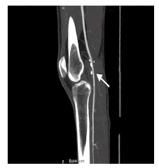 Angio-TC de control de las extremidades inferiores, reconstrucción
sagital: se evidencia permeabilidad del injerto venoso (flecha blanca),
el que muestra un adecuado calibre.